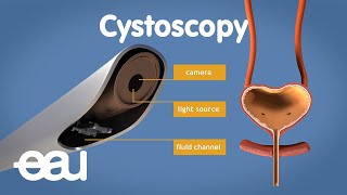 Cystoscopy overactive bladder [upl. by Centonze926]