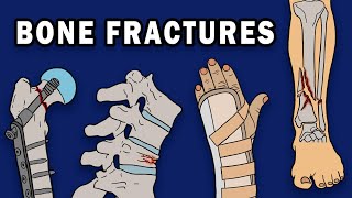 BONE FRACTURES [upl. by Eissirhc]