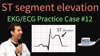 STEMI and NSTEMI Coding – How to Tell The Difference [upl. by Aligna]