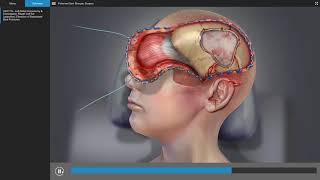 Trabeculectomy Surgery for Glaucoma Animation [upl. by Yssak]