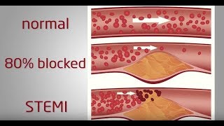 Evolution of a STEMI  Ausmed Explains [upl. by Cummine]