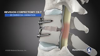 Medical Procedure Animation Visualizes Posterior Lumbar Microdiscectomy [upl. by Odnarb5]