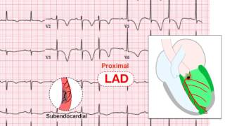 Myocardial Infarction MIHeart Attack Treatment in Emergency  Step wise STEMI Management USMLE [upl. by Anialahs989]