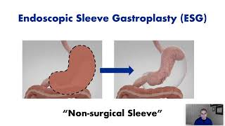 Endoscopic Sleeve Gastroplasty ESG  Procedure Overview [upl. by Asserak58]