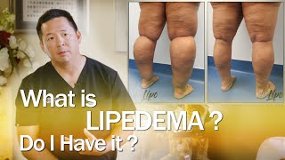 Lipedema Surgery Liposuction  Expert Dr Thomas Su  ArtLipo [upl. by Latsyrcal]