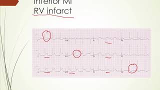 Akutes Koronarsyndrom STEMI VS NSTEMI [upl. by Hachman746]