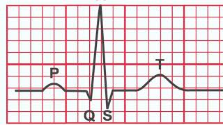 NHRMC Heart Center  STEMI Training Video [upl. by Keane]