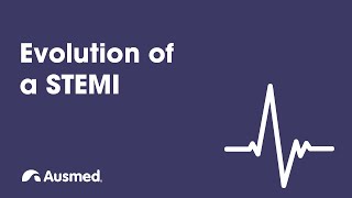 STsegment changes in STEMI amp NSTEMI explained [upl. by Forester]