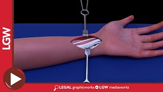 Wrist Fixator Surgery 3D Animation [upl. by Ymme]