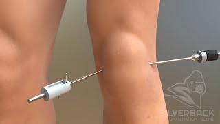 Knee Arthroscopy Animated Video [upl. by Poler]