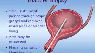 Cystoscopy [upl. by Accebber]