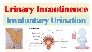 Frequent UTIs for Guys  Fairbanks Urology [upl. by Stallworth103]