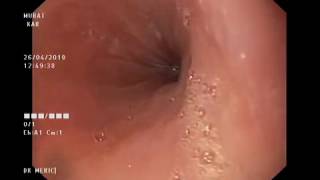 EGD  esophagogastroduodenoscopy [upl. by Eitsrik]