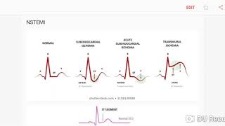 NSTEMI on ECG [upl. by Acirrehs]