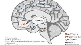 Neuropathology and Treatment of Hypersomnia [upl. by Enylekcaj]