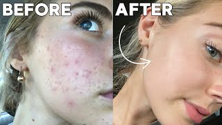 How I Cleared My Skin In 8 Weeks naturally [upl. by Cadel677]