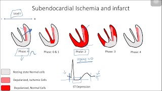 ST Elevation  EKG  ECG Interpretation Case 12 STEMI MI ACS [upl. by Jardena]