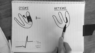 Ischemia 57 Examples of UA and NSTEMI [upl. by Conall]