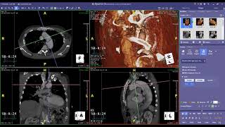 Thoracic Endovascular Aortic Repair TEVAR [upl. by Zitella]