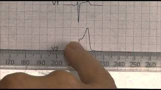 NSTEMI vs STEMI Differentiating Myocardial Infarctions [upl. by Aicilana]