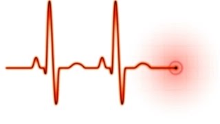 Easy EKG STEMI [upl. by Adham]