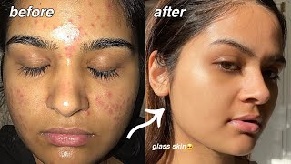 how i cleared my acne FOR GOOD something finally worked [upl. by Casie]