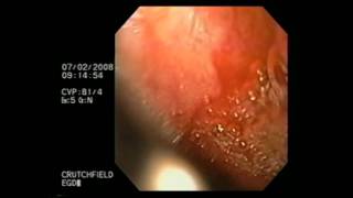 Esophagogastroduodenoscopy [upl. by Zaid]